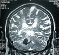 Article: Accidente cerebrovascular; template image