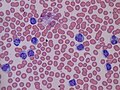 Article: Lymphocytosis