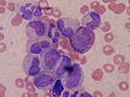 Article: Metamyelocyte